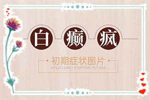 白癲瘋怎么治療好？[怎么治療比較好]兒童白癩癜風能嗎