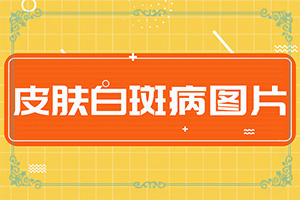 脖子上有白斑圖片-患者的皮膚癥狀是什么