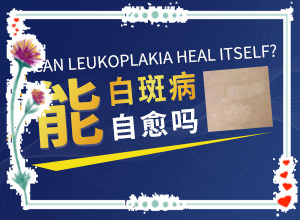 白癲瘋手上能治愈嗎[什么方法治療]哪個(gè)治療白癲好