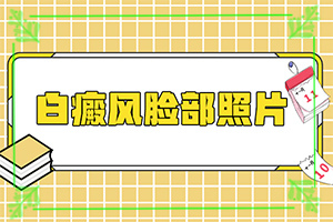 得白癜風(fēng)的概率-孕婦患有白癜風(fēng)會(huì)遺傳給胎兒嘛