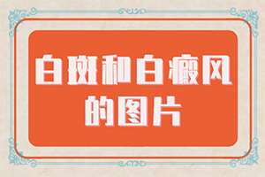 眉毛上出現(xiàn)白斑-身上一塊白斑-做什么檢查好呢