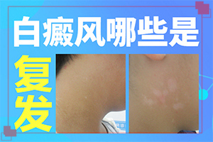 白班初期癥狀,表現(xiàn)癥狀是啥(怎么判斷)