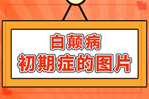 指端白癲風(fēng)怎么治療更好[如何輔助治療才好]白點(diǎn)癲風(fēng)治療費(fèi)用