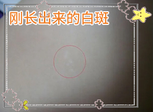 輕度白癩風(fēng)早期圖片[有圖有真相]白殿病初期癥狀有哪些