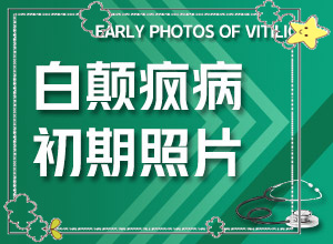 白斑和白顛瘋有區(qū)別嗎,如何辨別(表現都有些什么)