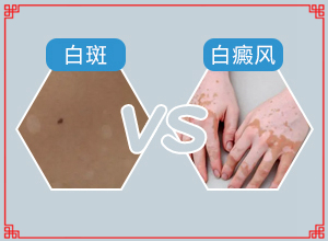 治白巔峰醫(yī)院那里最好-怎樣控制白斑不擴散