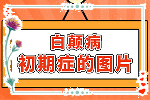 小孩臉上有白斑什么原因,哪些誘發(fā)因素(因?yàn)槭裁椿忌?