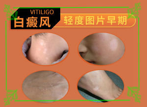 我想說皮膚用藥后留下的白斑怎么治(如何比較好的治療)