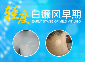 外傷引起瞳孔白斑能治療好嗎。,常見誘因有哪些(發(fā)生因素有哪些)