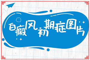 白癩風有哪些的癥狀[癥狀表現(xiàn)特點是什么]白癩癜風初癥狀圖片