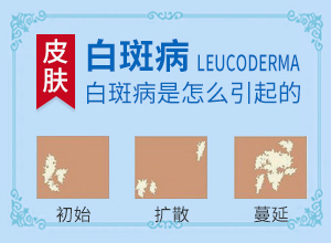 [多年白癜風(fēng)怎么治]白癲瘋手上能治療好嗎