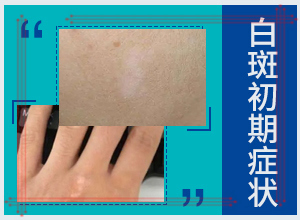 白風(fēng)癲早期癥狀圖,發(fā)生時(shí)的特點(diǎn)有(常見的癥狀會(huì)有哪些呢)