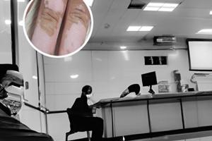 去年得過(guò)敏性紫癲好了以后身體長(zhǎng)了一塊白斑一年了沒(méi)什么變化